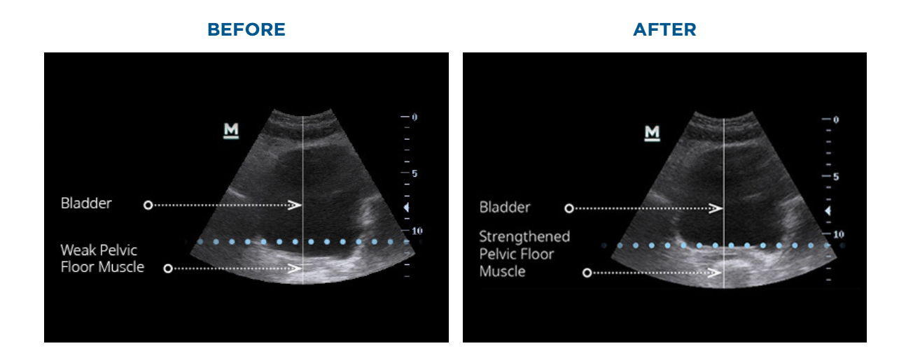 Before and after results of pelvic floor magnetic stimulation therapy for bladder dysfunction and urinary incontinence at SENSE Health Bangalore